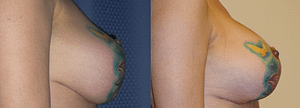 Breast Revision Before & After Photos