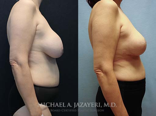 breast revision in orange county before and after of the right