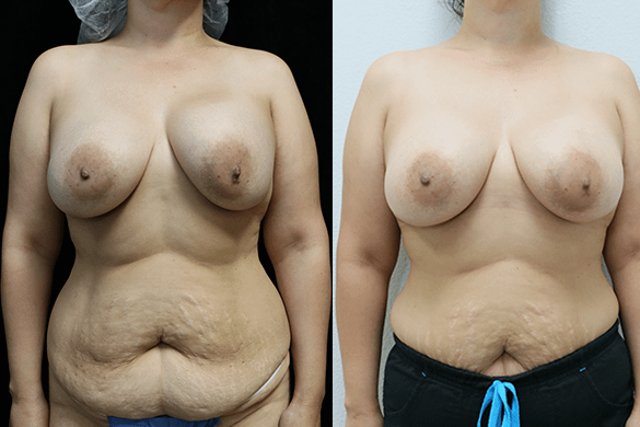Breast Revision before and after results front