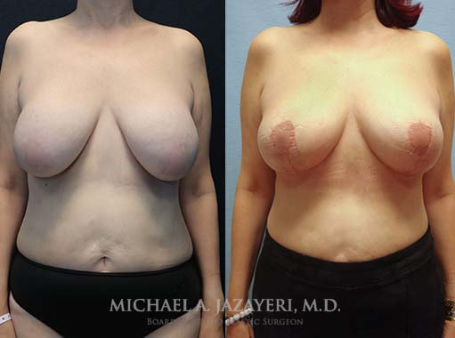 breast revision in orange county before and after of the front