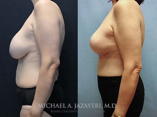 breast revision in orange county before and after of the left