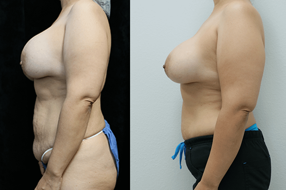 Breast Revision before and after results left