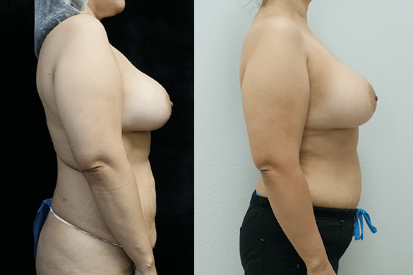 Breast Revision before and after results right