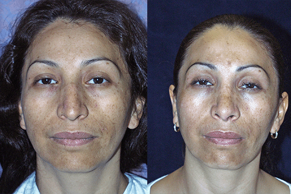 Rhinoplasty Before & After Photos Front