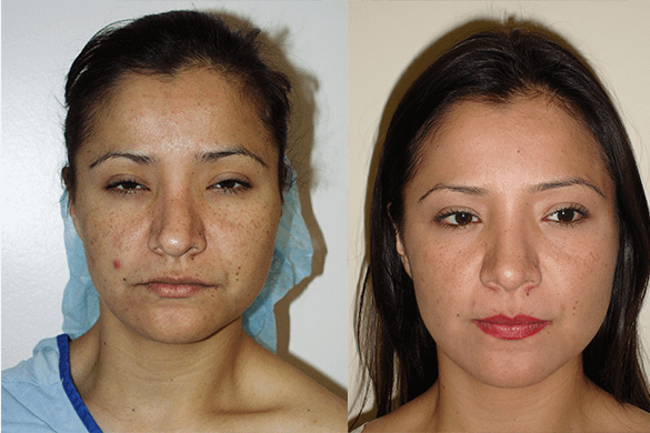 Rhinoplasty Before & After Photos Front