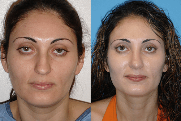 Rhinoplasty Before & After Photos Front