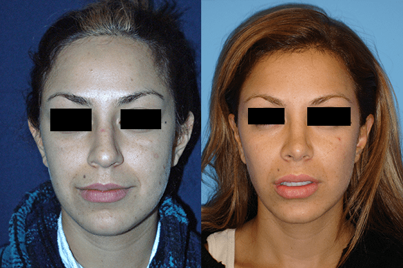 Rhinoplasty Before & After Photos Front