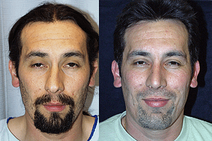 Rhinoplasty Before & After Photos Front