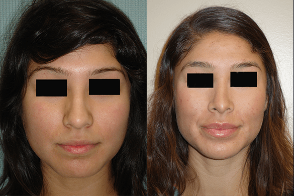 Rhinoplasty Before & After Photos Front