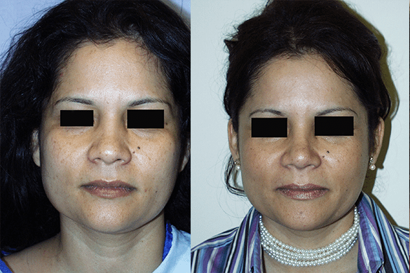 Rhinoplasty Before & After Photos Front