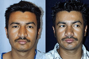 Rhinoplasty Before & After Photos Front