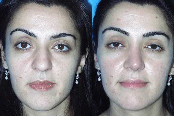 Rhinoplasty Before & After Photos Front