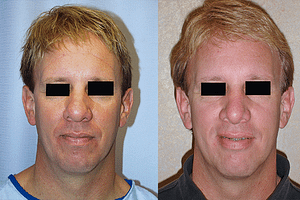 Rhinoplasty Before & After Photos Front