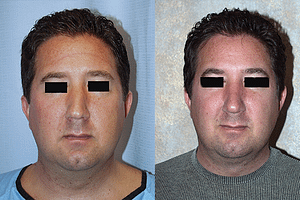 Rhinoplasty Before & After Photos