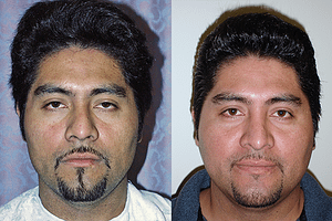 Rhinoplasty Before & After Photos Front