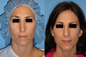 Rhinoplasty Before & After Photos