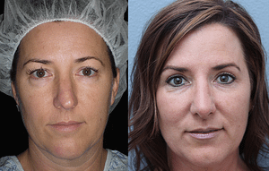 Rhinoplasty Before & After Photos
