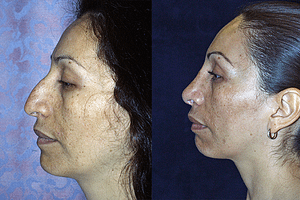 Rhinoplasty Before & After Photos Left