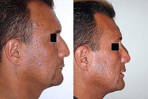 Rhinoplasty Before & After Photos Right