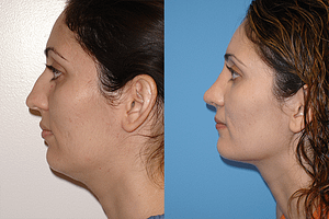 Rhinoplasty Before & After Photos Left