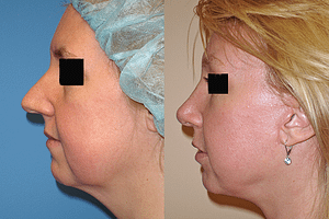 Rhinoplasty Before & After Photos Left
