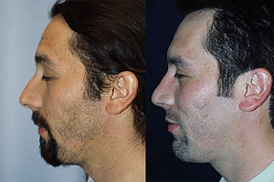 Rhinoplasty Before & After Photos Left