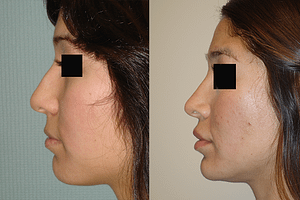 Rhinoplasty Before & After Photos Left