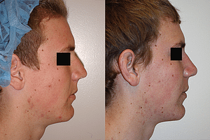 Rhinoplasty Before & After Photos Right