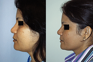 Rhinoplasty Before & After Photos Left