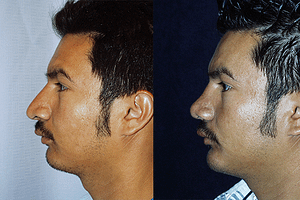 Rhinoplasty Before & After Photos Left