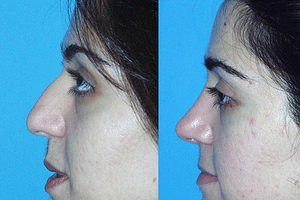 Rhinoplasty Before & After Photos Left