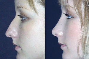 Rhinoplasty Before & After Photos Left