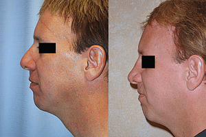 Rhinoplasty Before & After Photos Left