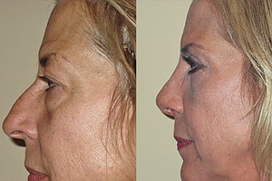 Rhinoplasty & Eyelid Surgery Before & After Photos Left