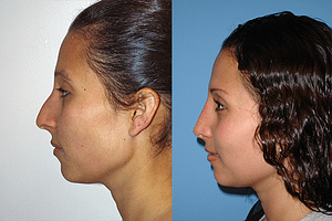 Rhinoplasty Before & After Photos Left
