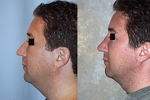 Rhinoplasty Before & After Photos Left