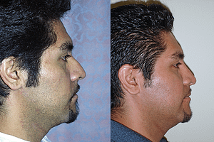 Rhinoplasty Before & After Photos Right