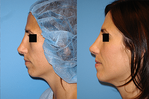 Rhinoplasty Before & After Photos Left