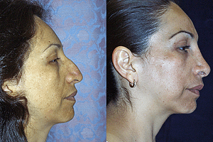 Rhinoplasty Before & After Photos Right