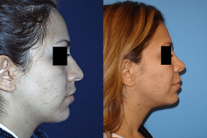 Rhinoplasty Before & After Photos Right