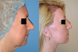 Rhinoplasty Before & After Photos Right
