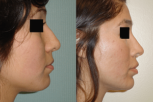 Rhinoplasty Before & After Photos Right
