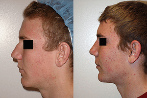 Rhinoplasty Before & After Photos Left