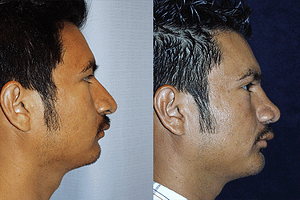 Rhinoplasty Before & After Photos Right
