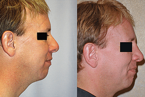 Rhinoplasty Before & After Photos Right