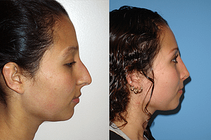 Rhinoplasty Before & After Photos Right