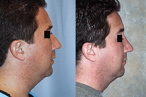 Rhinoplasty Before & After Photos