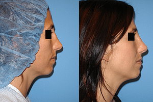 Rhinoplasty Before & After Photos Right