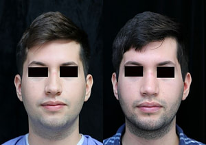 chin augmentation, rhinoplasty, neck liposuction front