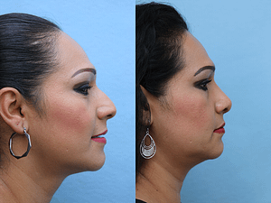 Rhinoplasty Before & After Photos Right Side